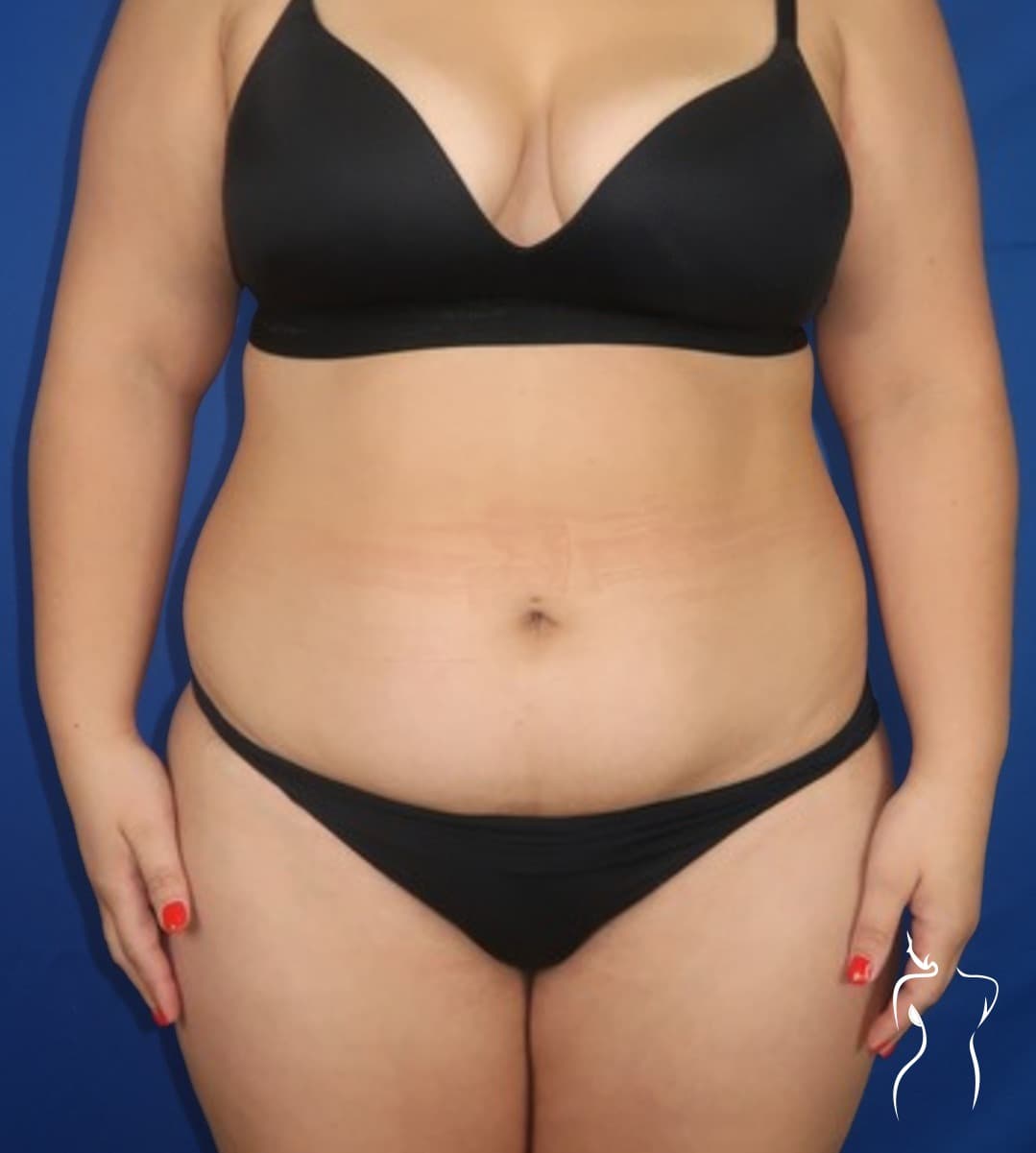 Abdominoplasty, before — actual patient of Dr. Day