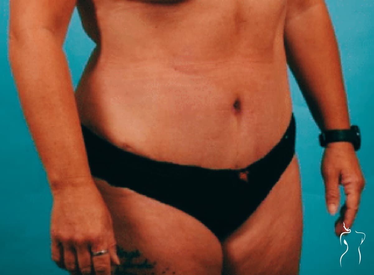 Abdominoplasty, after — actual patient of Dr. Day