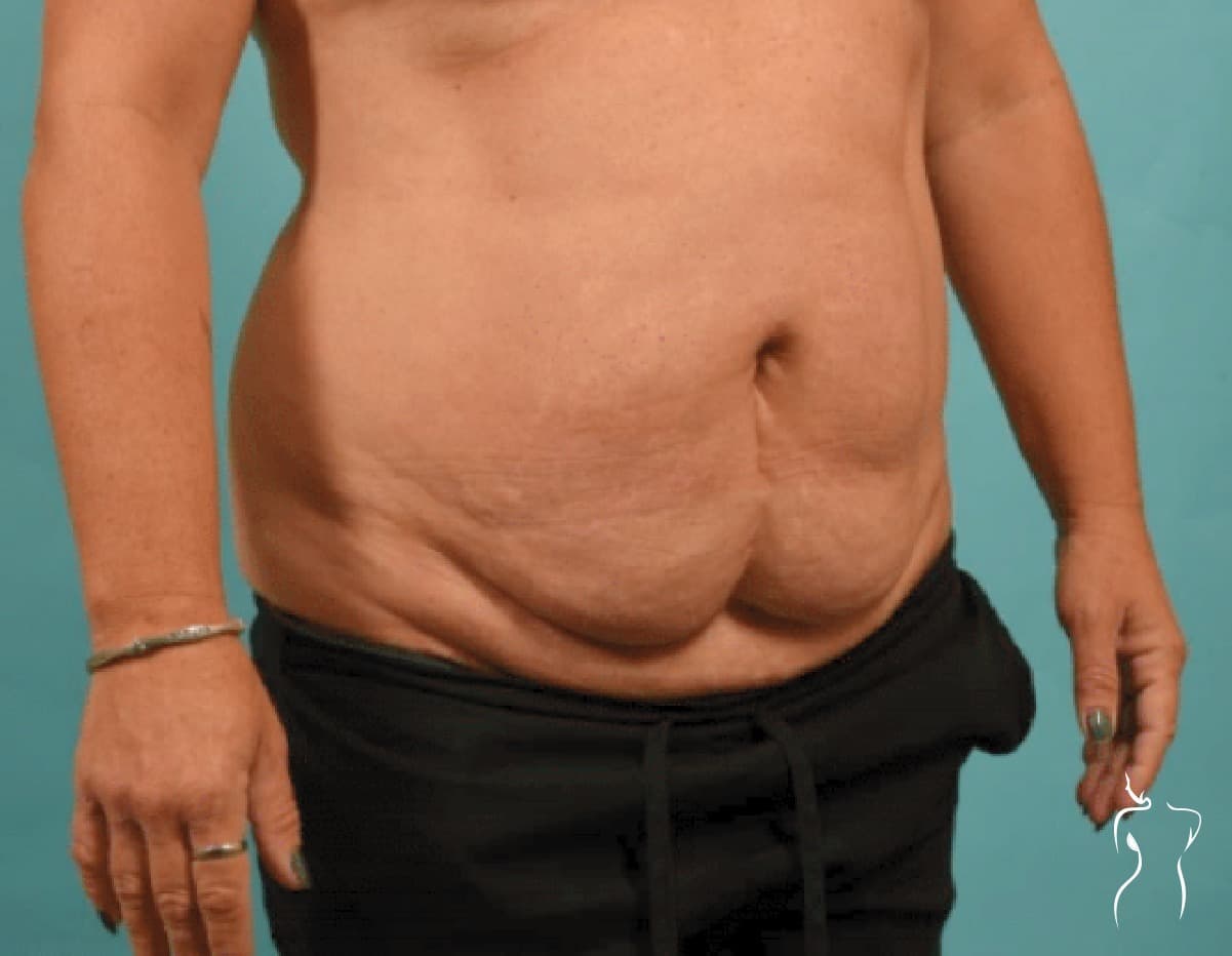 Abdominoplasty, before — actual patient of Dr. Day