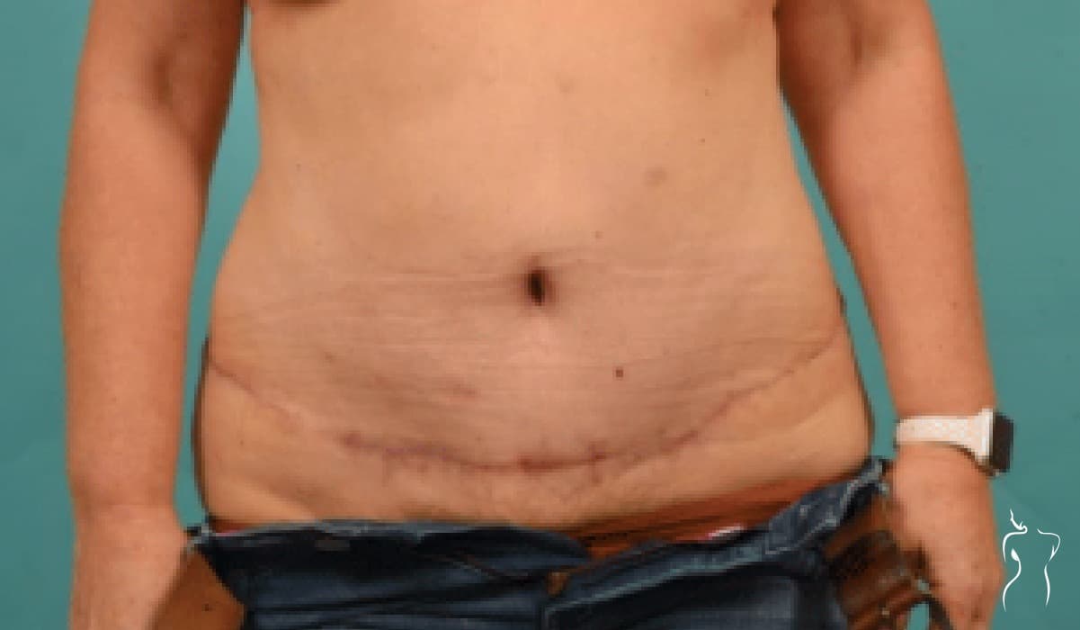Abdominoplasty, after — actual patient of Dr. Day