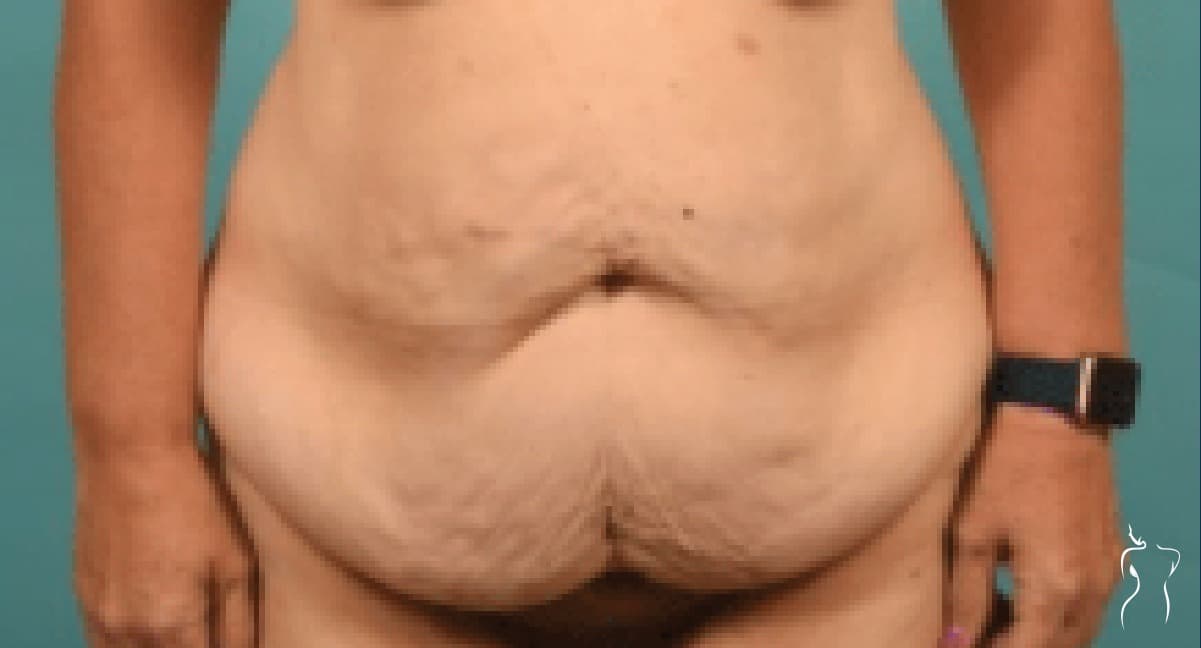 Abdominoplasty, before — actual patient of Dr. Day