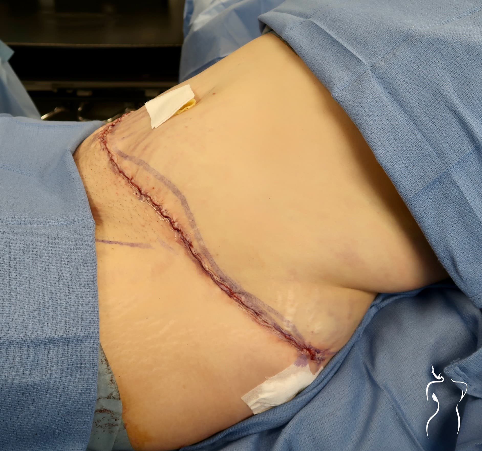 Abdominoplasty, after — actual patient of Dr. Day