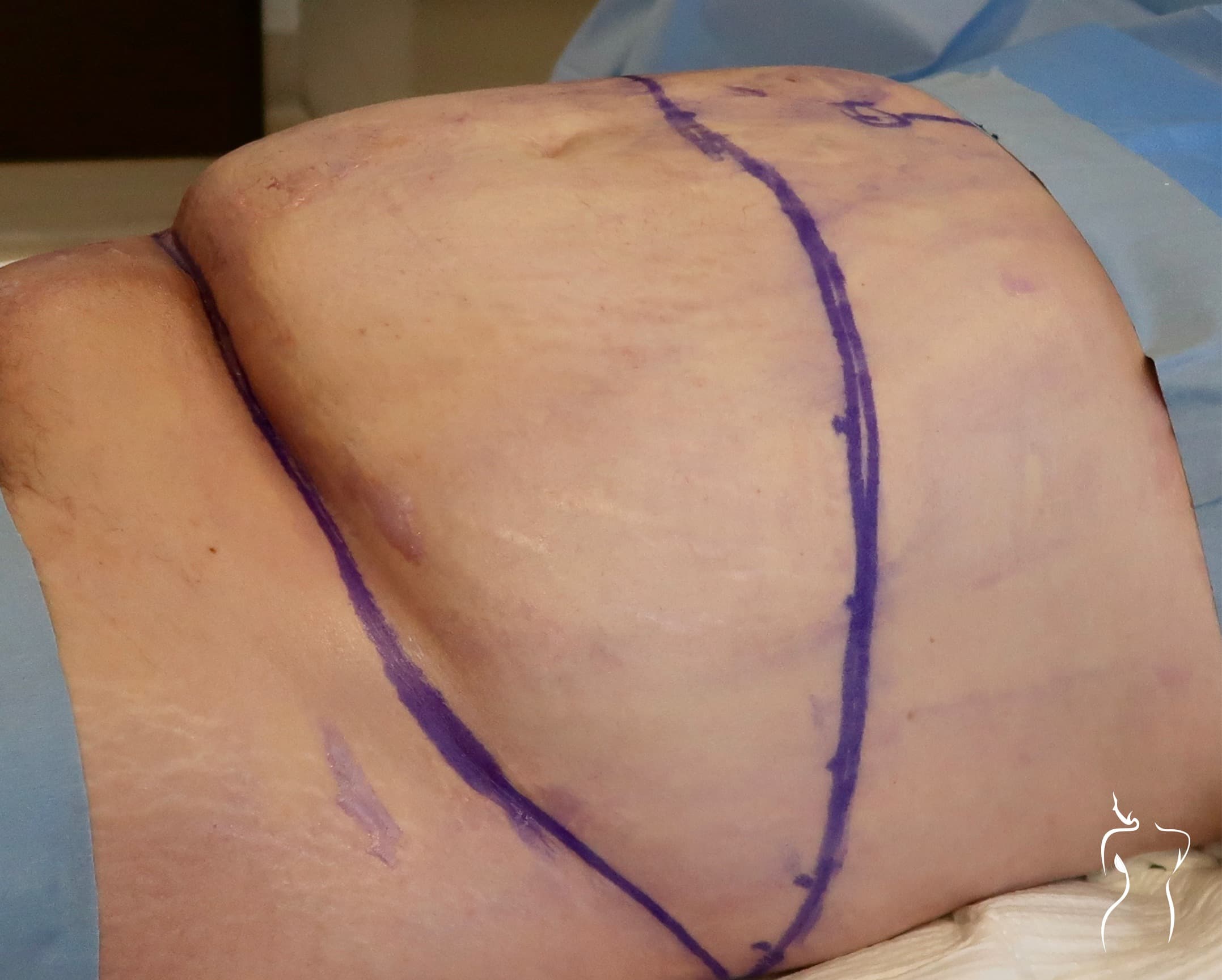 Abdominoplasty, before — actual patient of Dr. Day