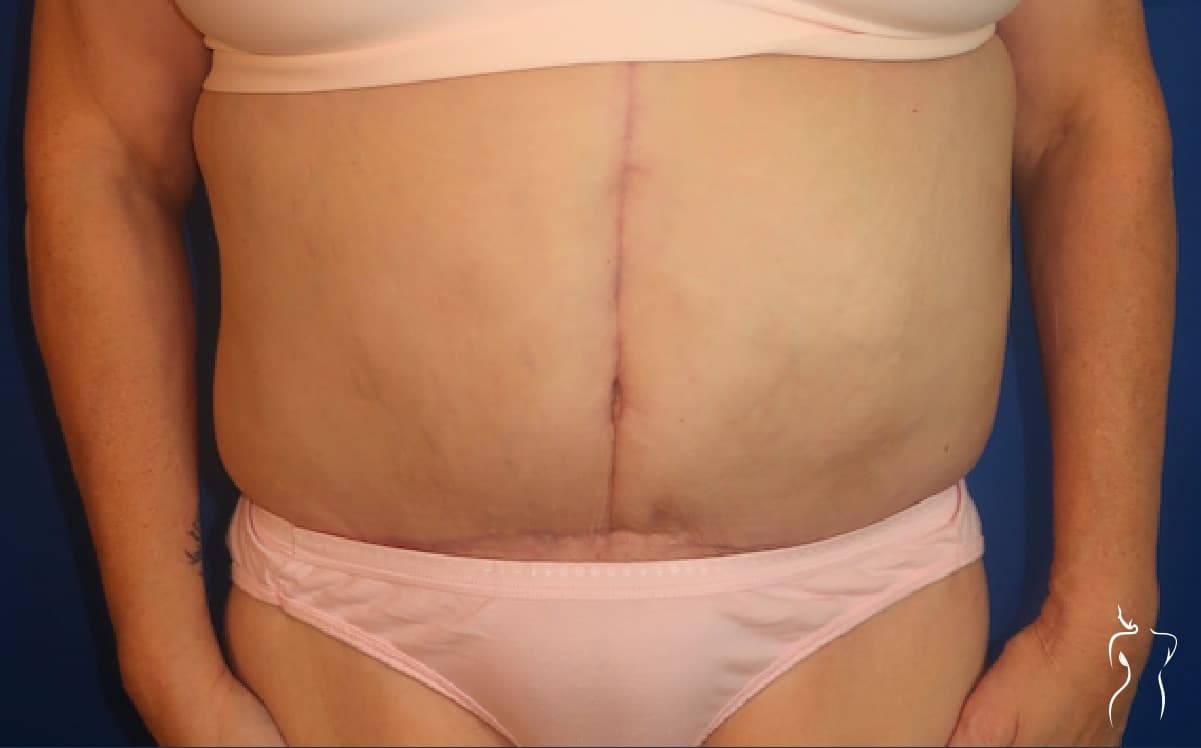 Abdominoplasty, after — actual patient of Dr. Day
