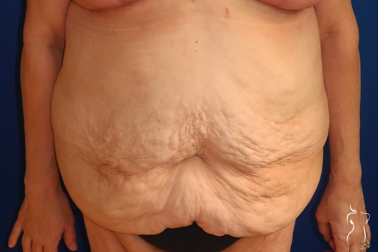 Abdominoplasty, before — actual patient of Dr. Day