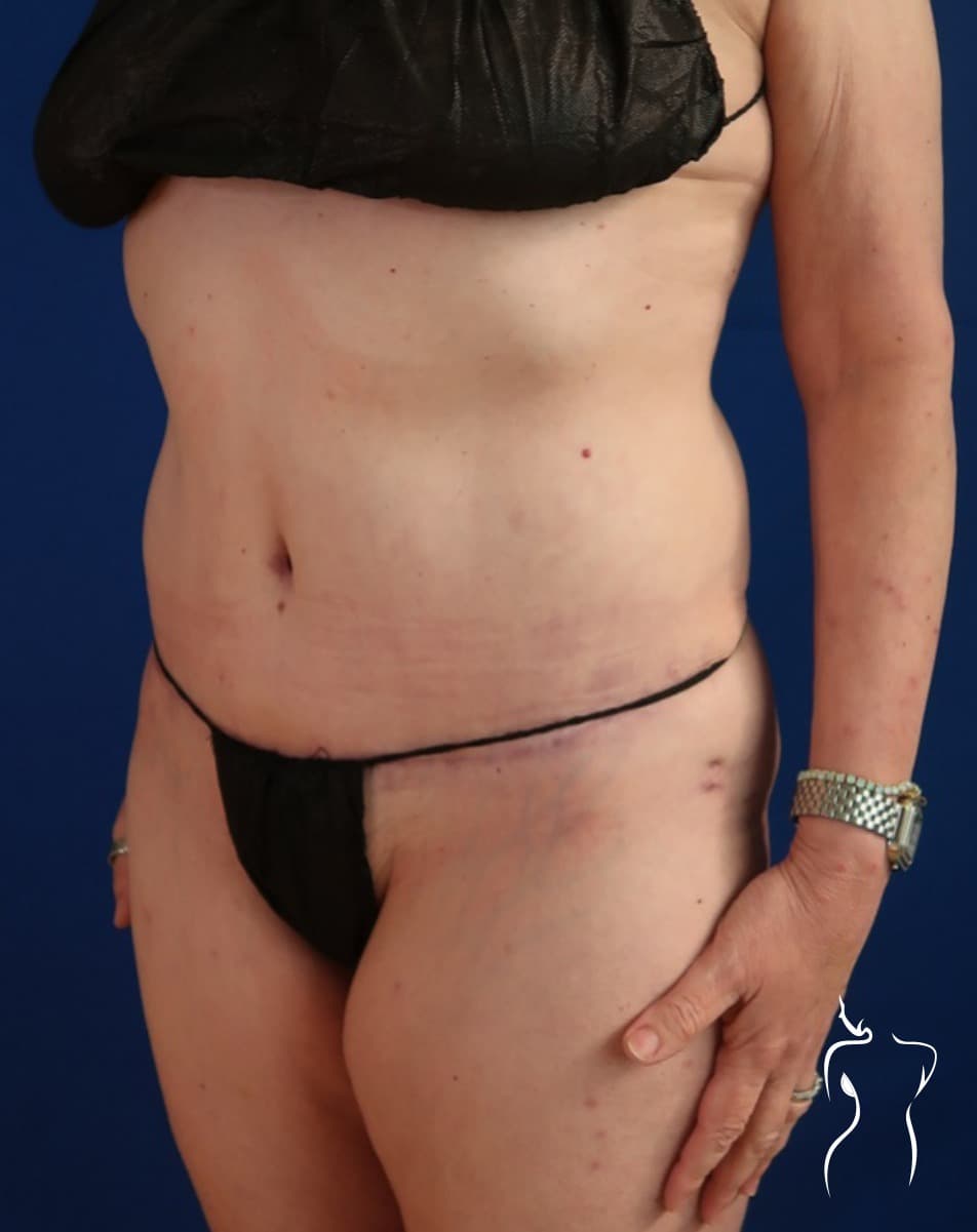 Abdominoplasty, after — actual patient of Dr. Day