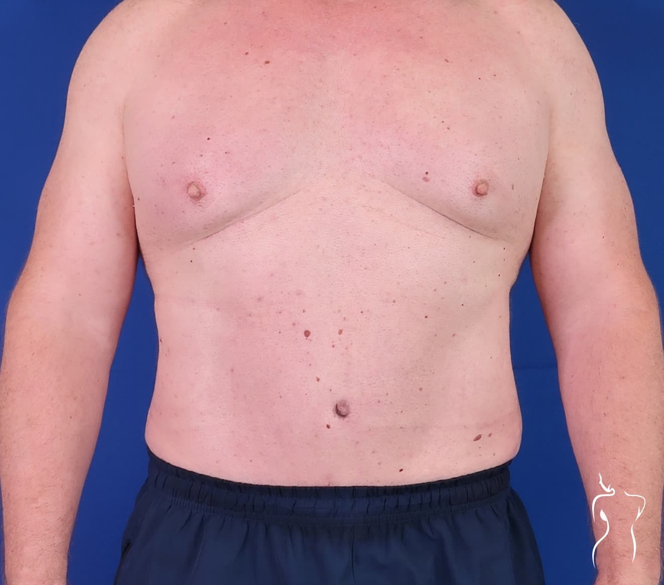 Abdominoplasty, after — actual patient of Dr. Day