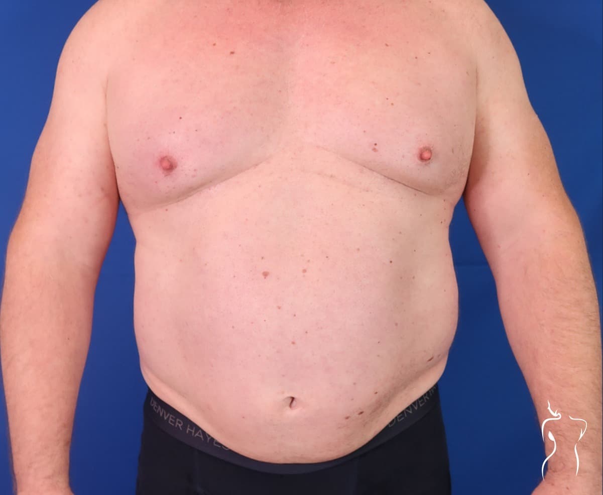 Abdominoplasty, before — actual patient of Dr. Day
