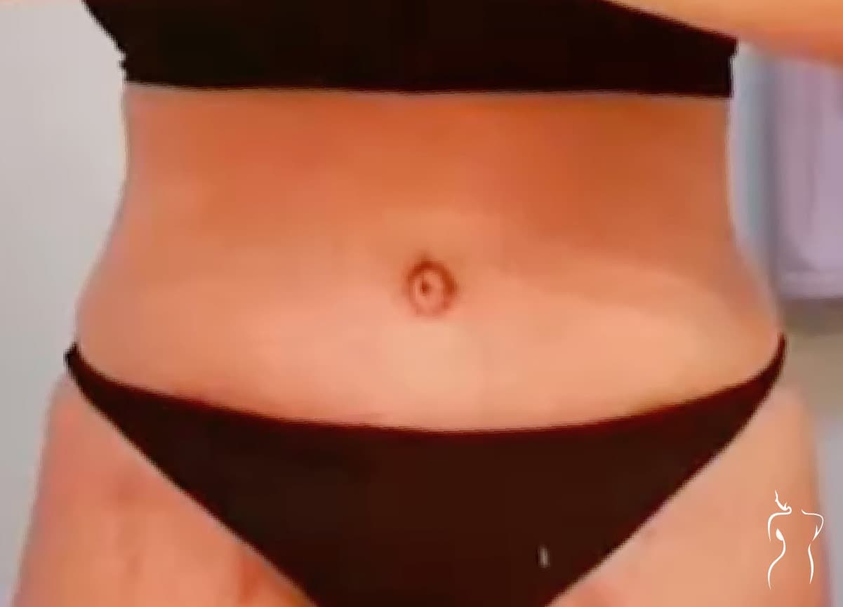 Abdominoplasty, after — actual patient of Dr. Day