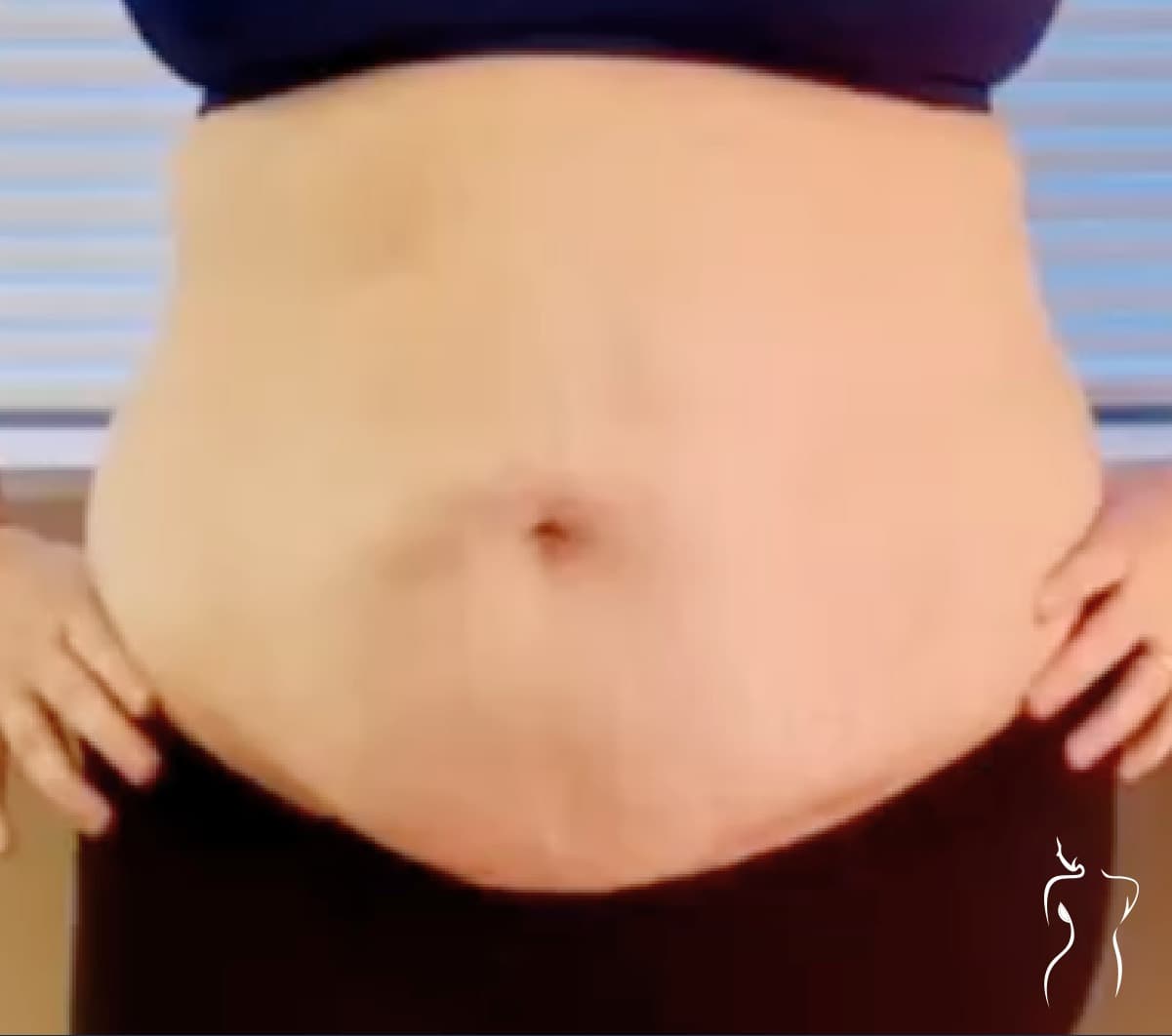 Abdominoplasty, before — actual patient of Dr. Day