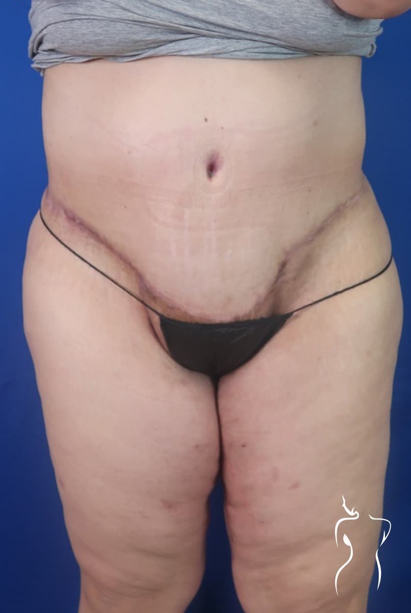 Abdominoplasty, after — actual patient of Dr. Day