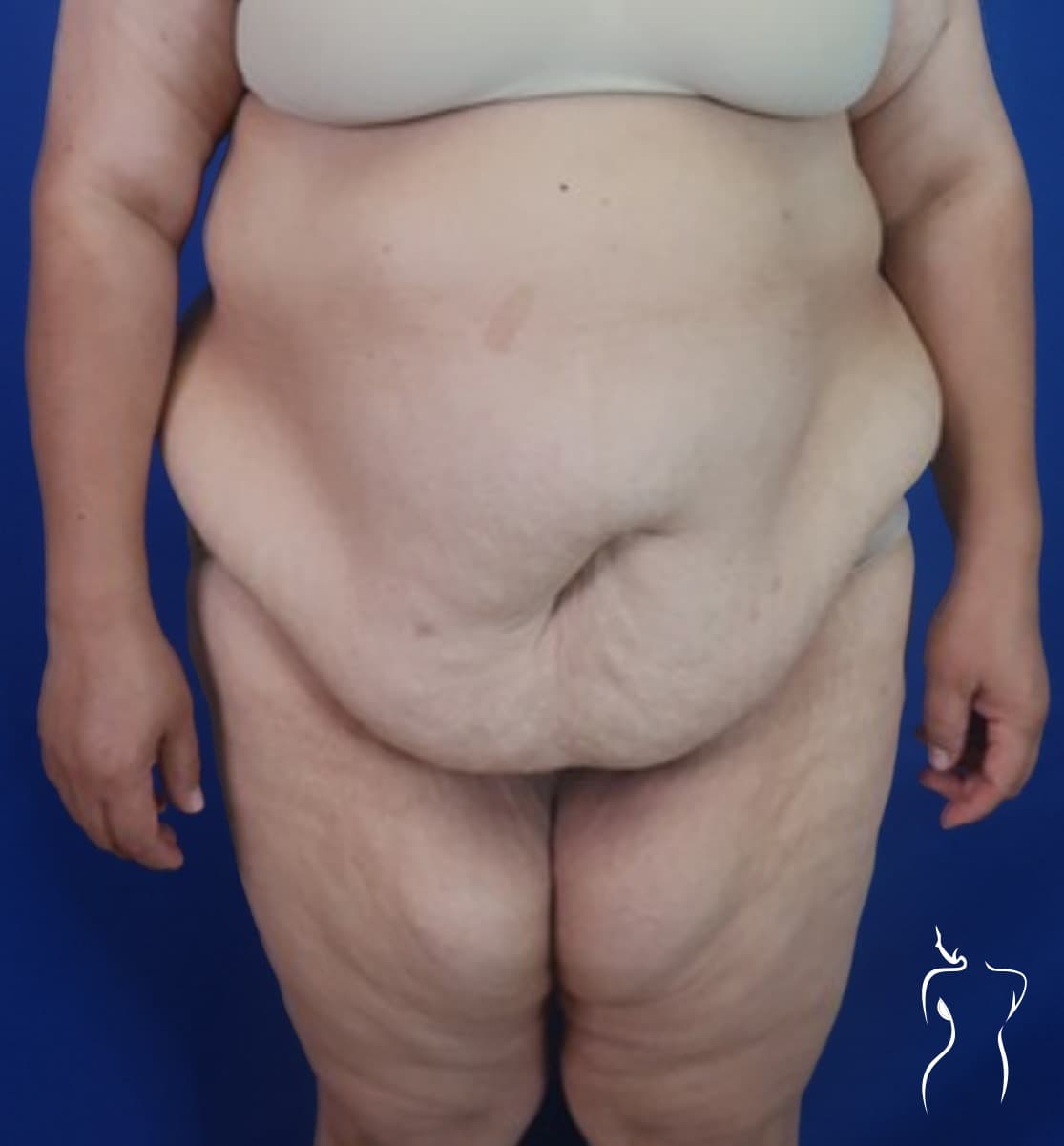 Abdominoplasty, before — actual patient of Dr. Day