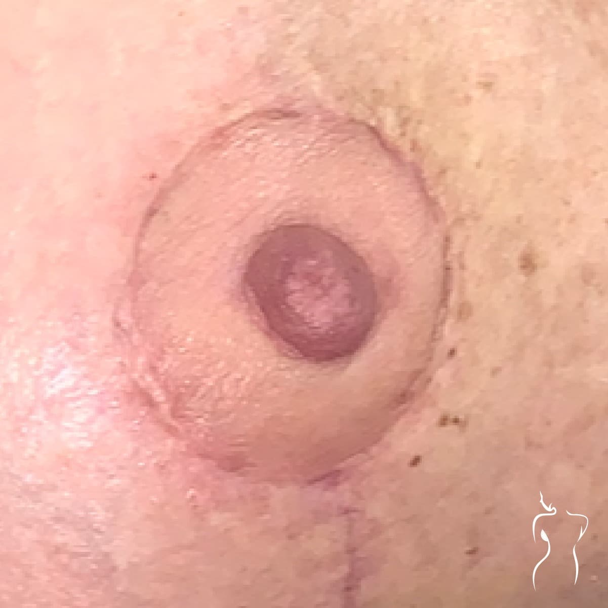 Nipple & Areola Reduction, after — actual patient of Dr. Day
