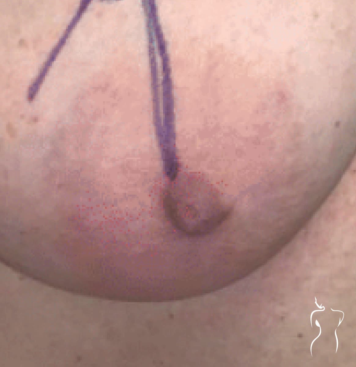 Nipple & Areola Reduction, before — actual patient of Dr. Day
