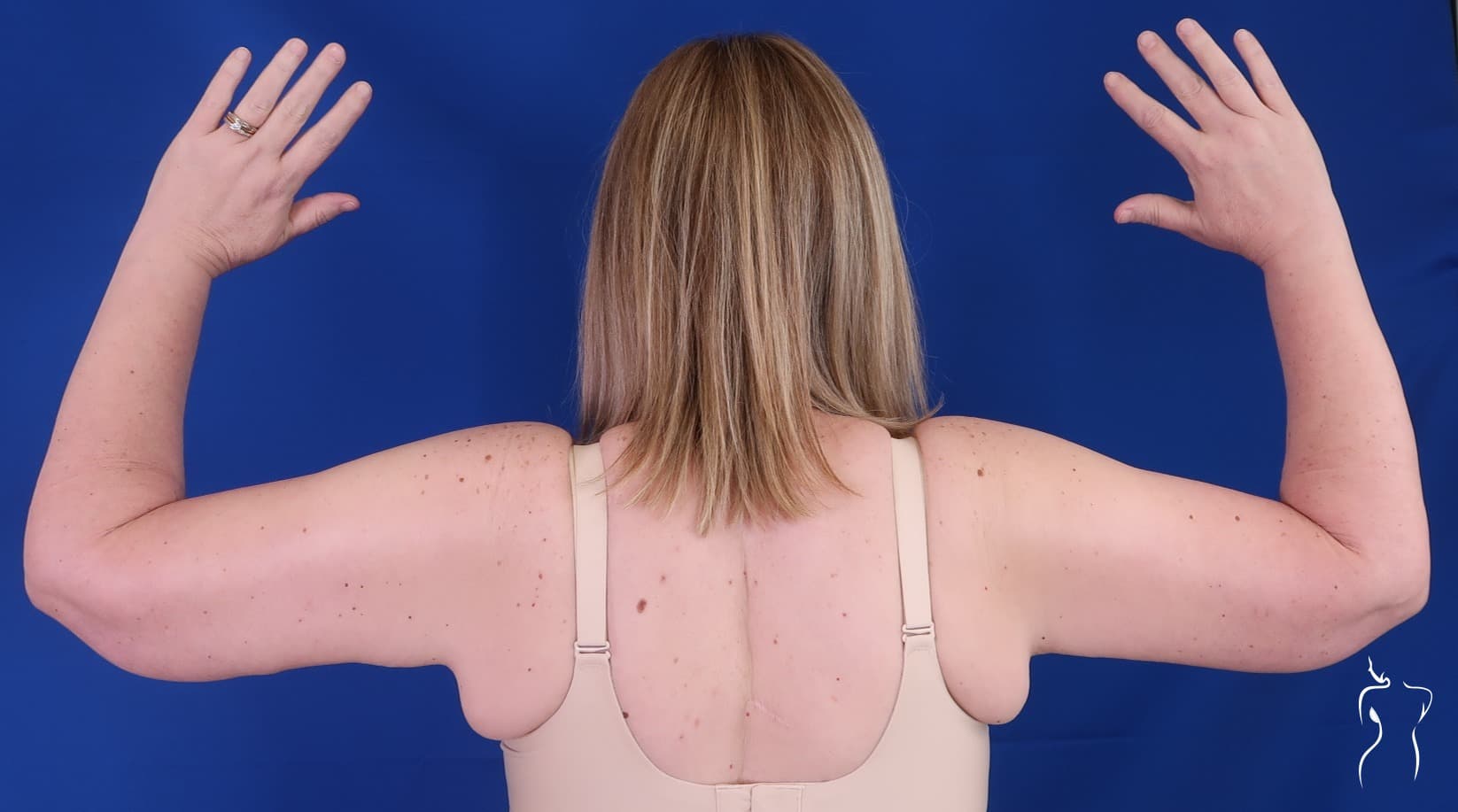 Arm Lift, after — actual patient of Dr. Day
