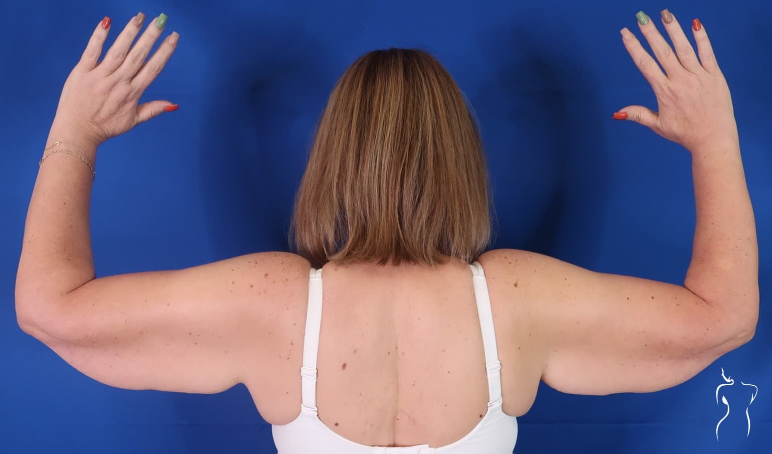 Arm Lift, before — actual patient of Dr. Day