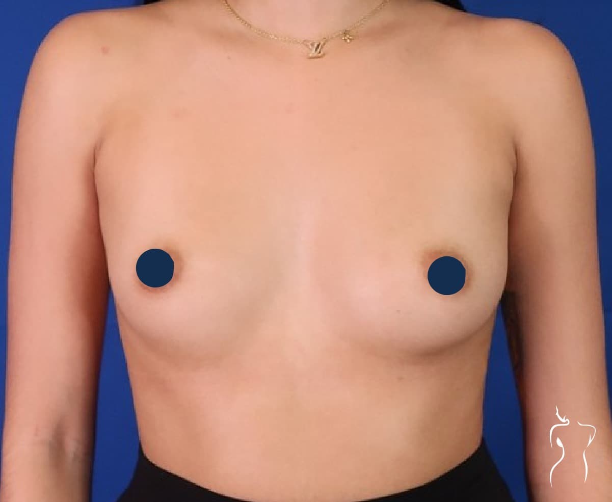 Breast Augmentation, before — actual patient of Dr. Day