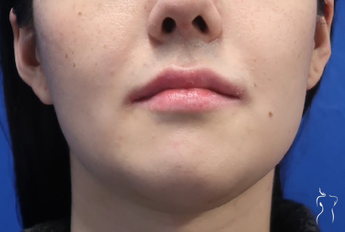 Chin Contouring, after — actual patient of Dr. Day