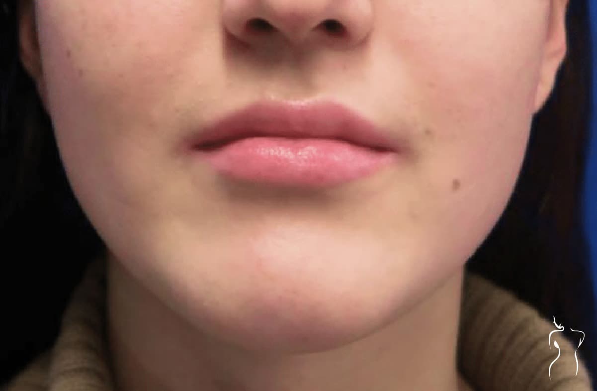 Chin Contouring, before — actual patient of Dr. Day