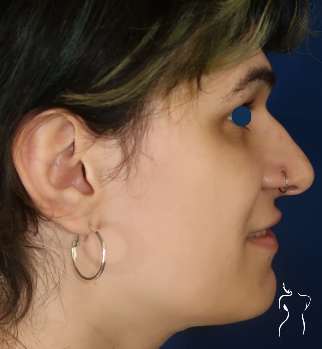 Chin Contouring, after — actual patient of Dr. Day