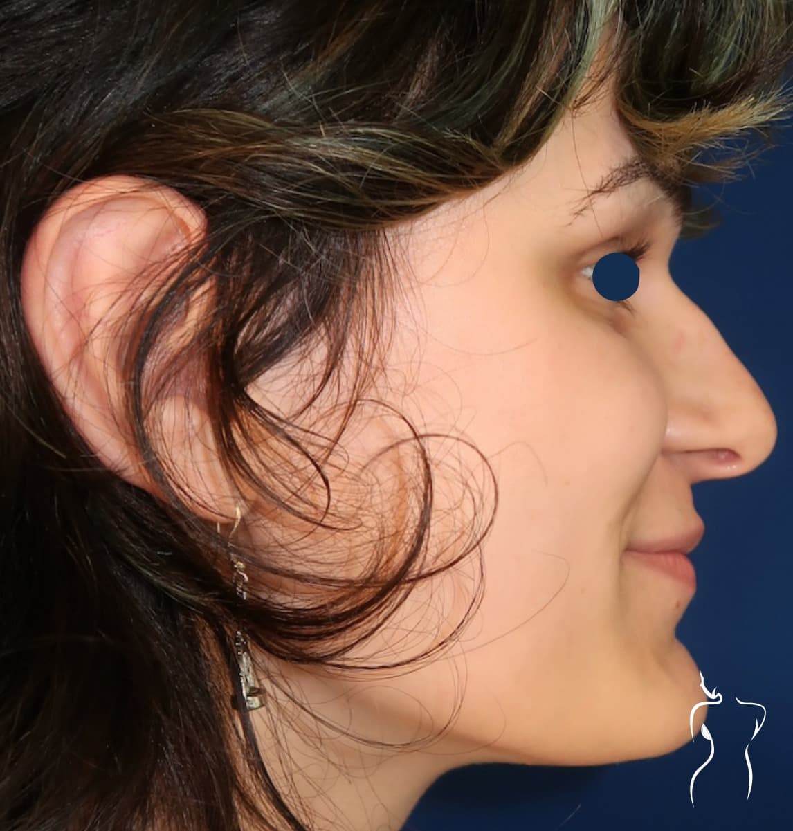 Chin Contouring, before — actual patient of Dr. Day