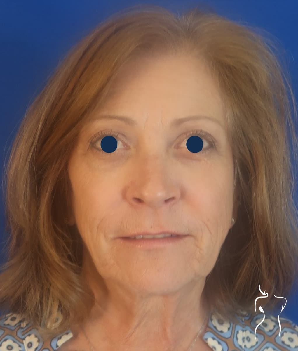 Face & Neck Lift, before — actual patient of Dr. Day