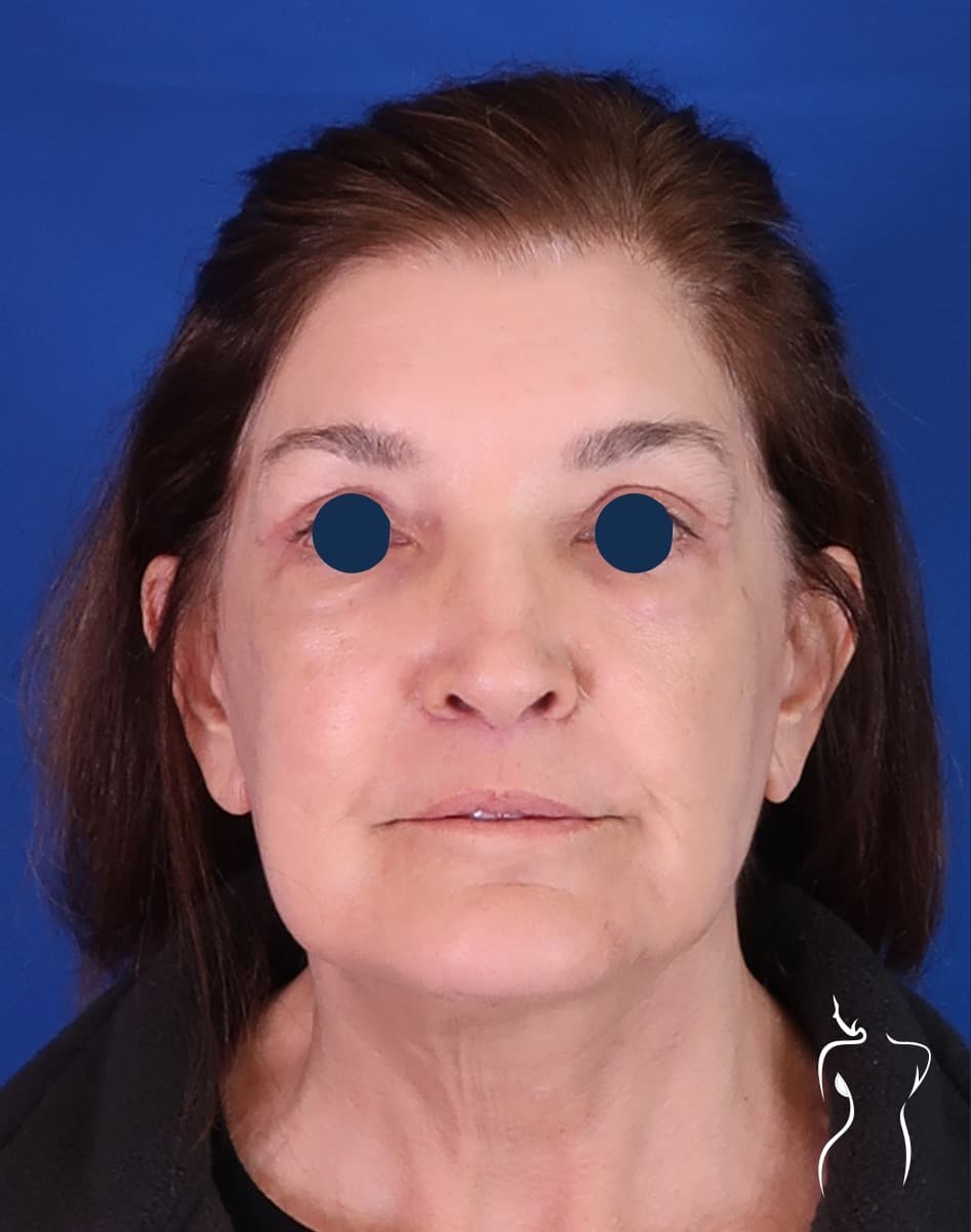 Face & Neck Lift, after — actual patient of Dr. Day