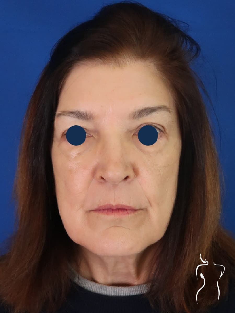 Face & Neck Lift, before — actual patient of Dr. Day
