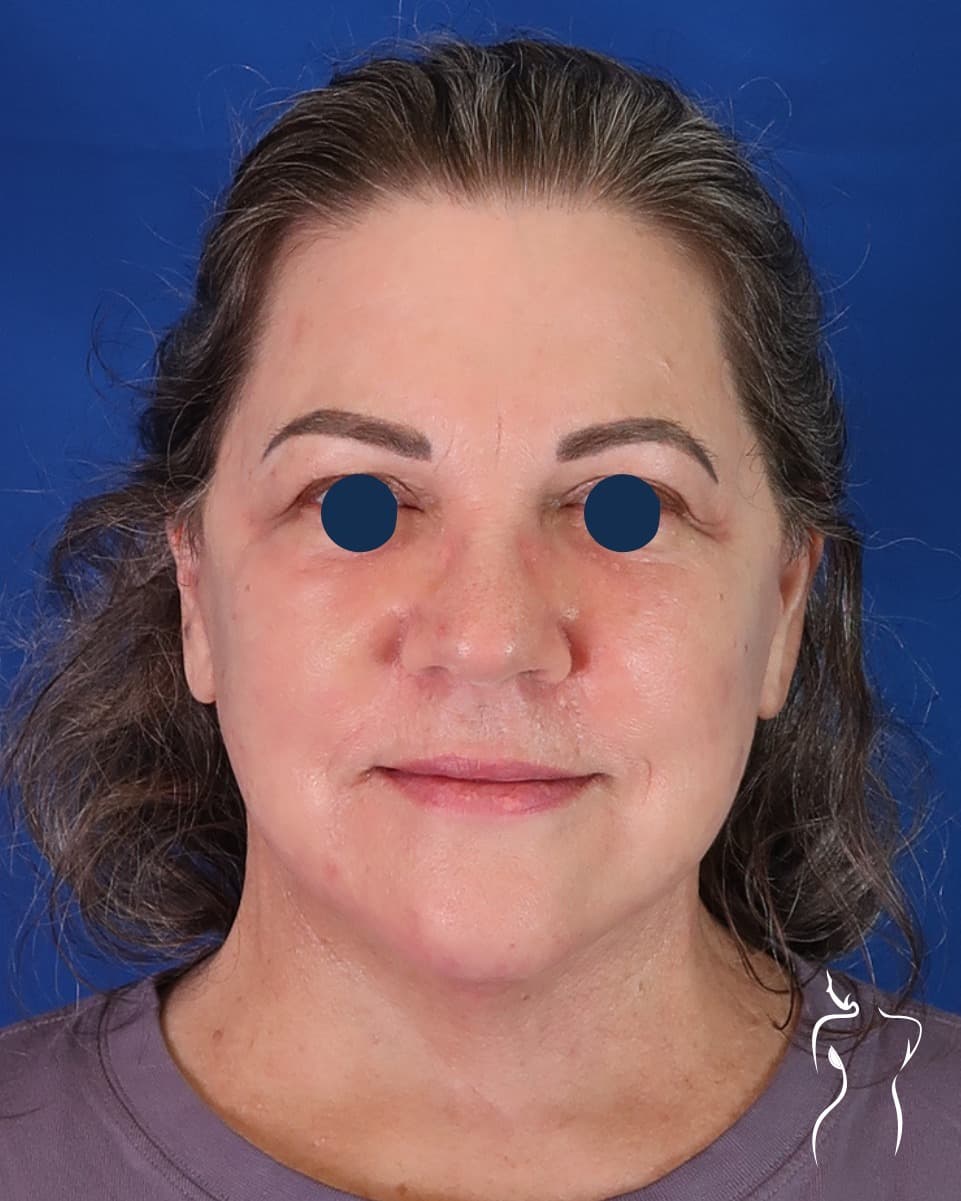 Face & Neck Lift, after — actual patient of Dr. Day