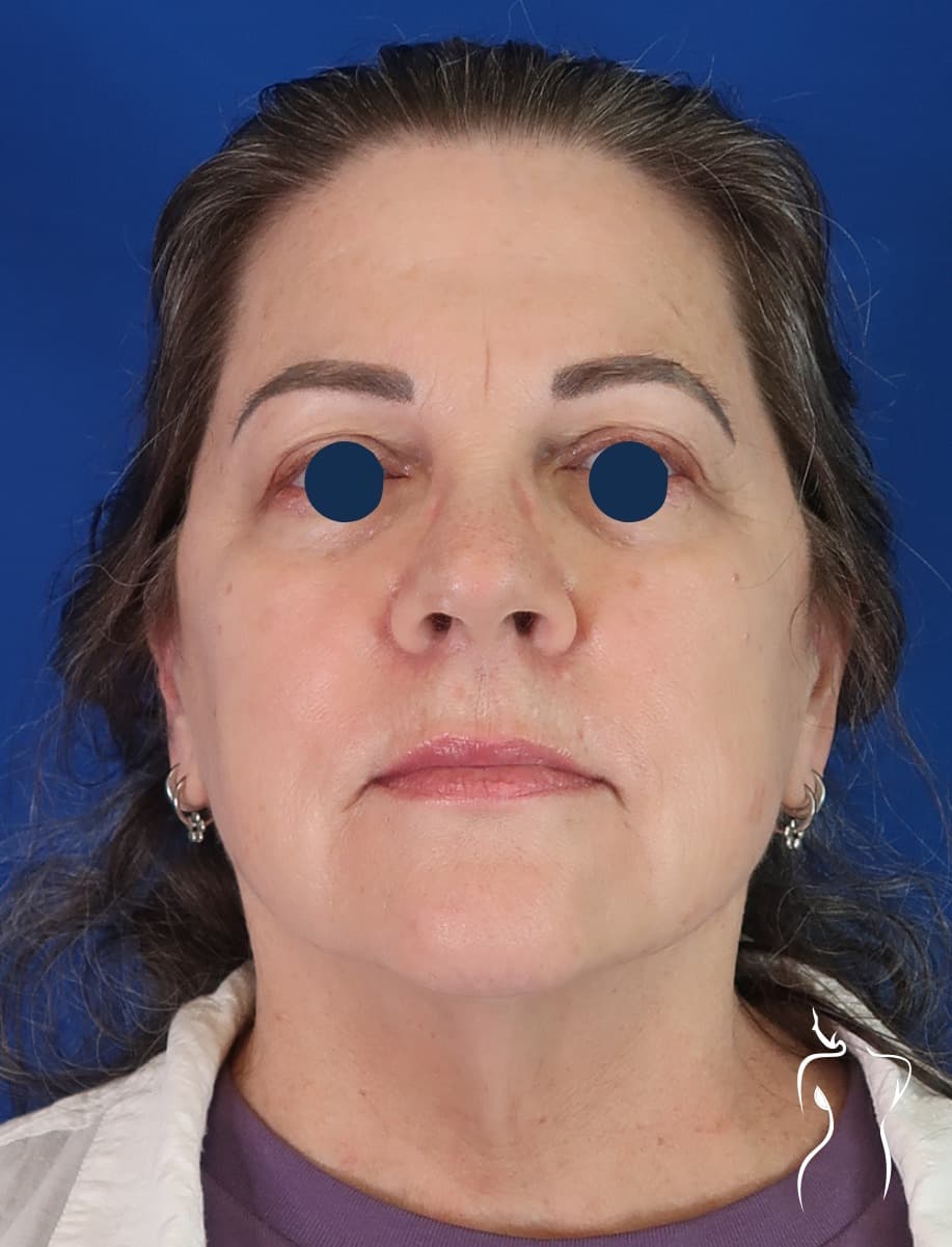 Face & Neck Lift, before — actual patient of Dr. Day