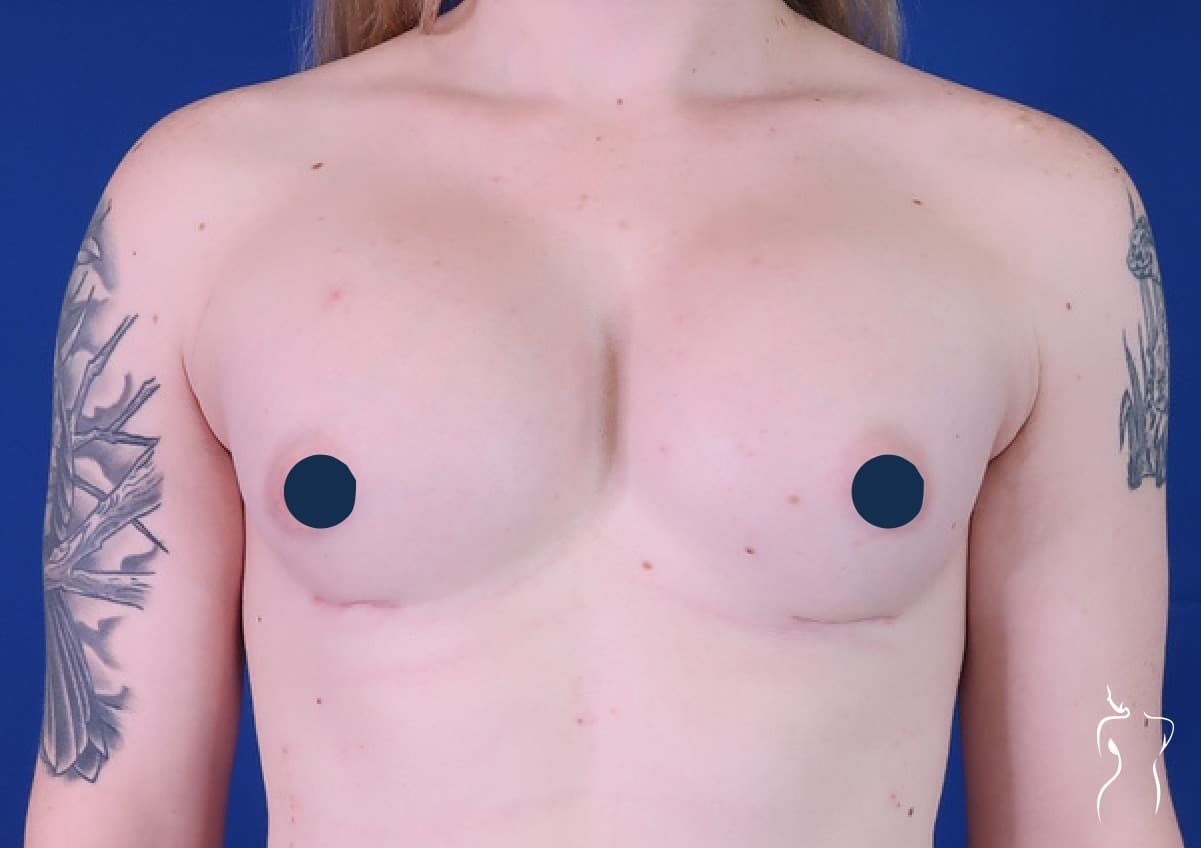 Gender-Affirming Breast Augmentation, after — actual patient of Dr. Day