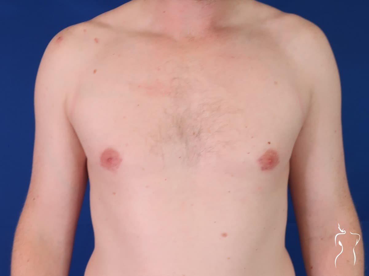Gynecomastia, after — actual patient of Dr. Day