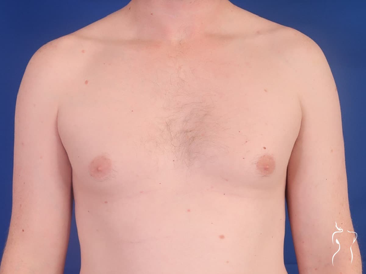 Gynecomastia, before — actual patient of Dr. Day