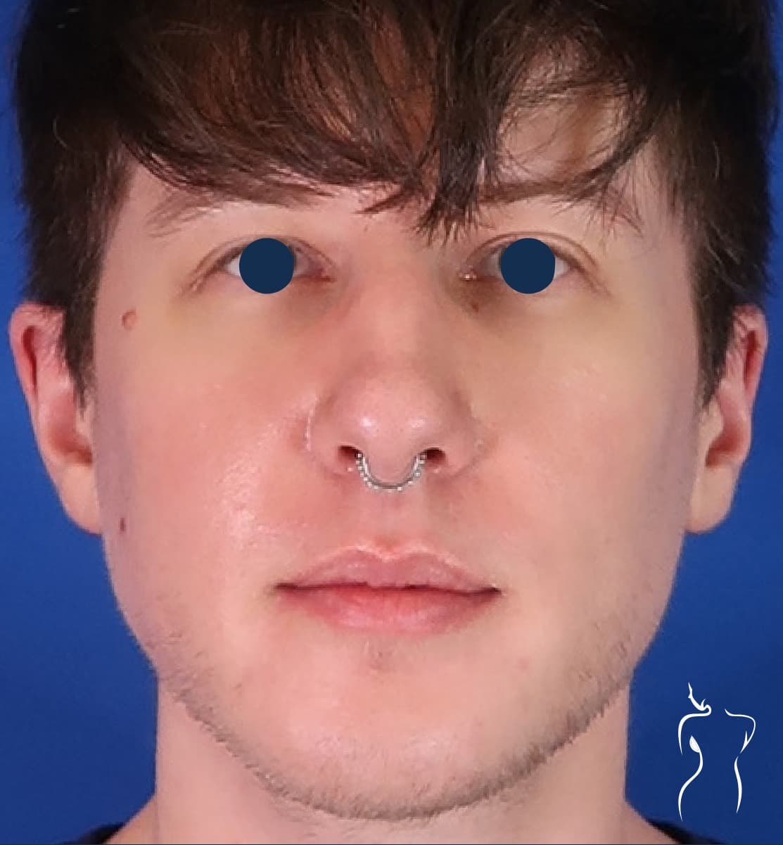 Facial Implants, after — actual patient of Dr. Day