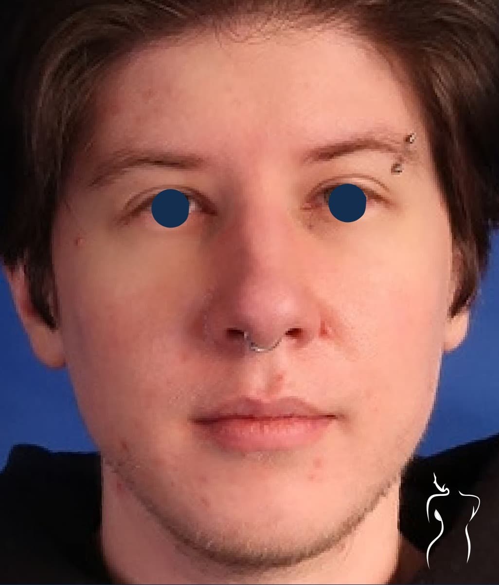 Facial Implants, before — actual patient of Dr. Day