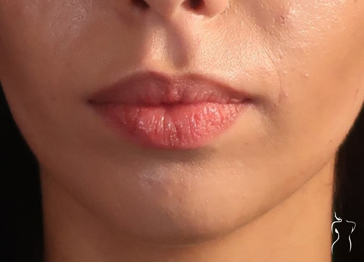 Dermal Fillers, after — actual patient of Dr. Day