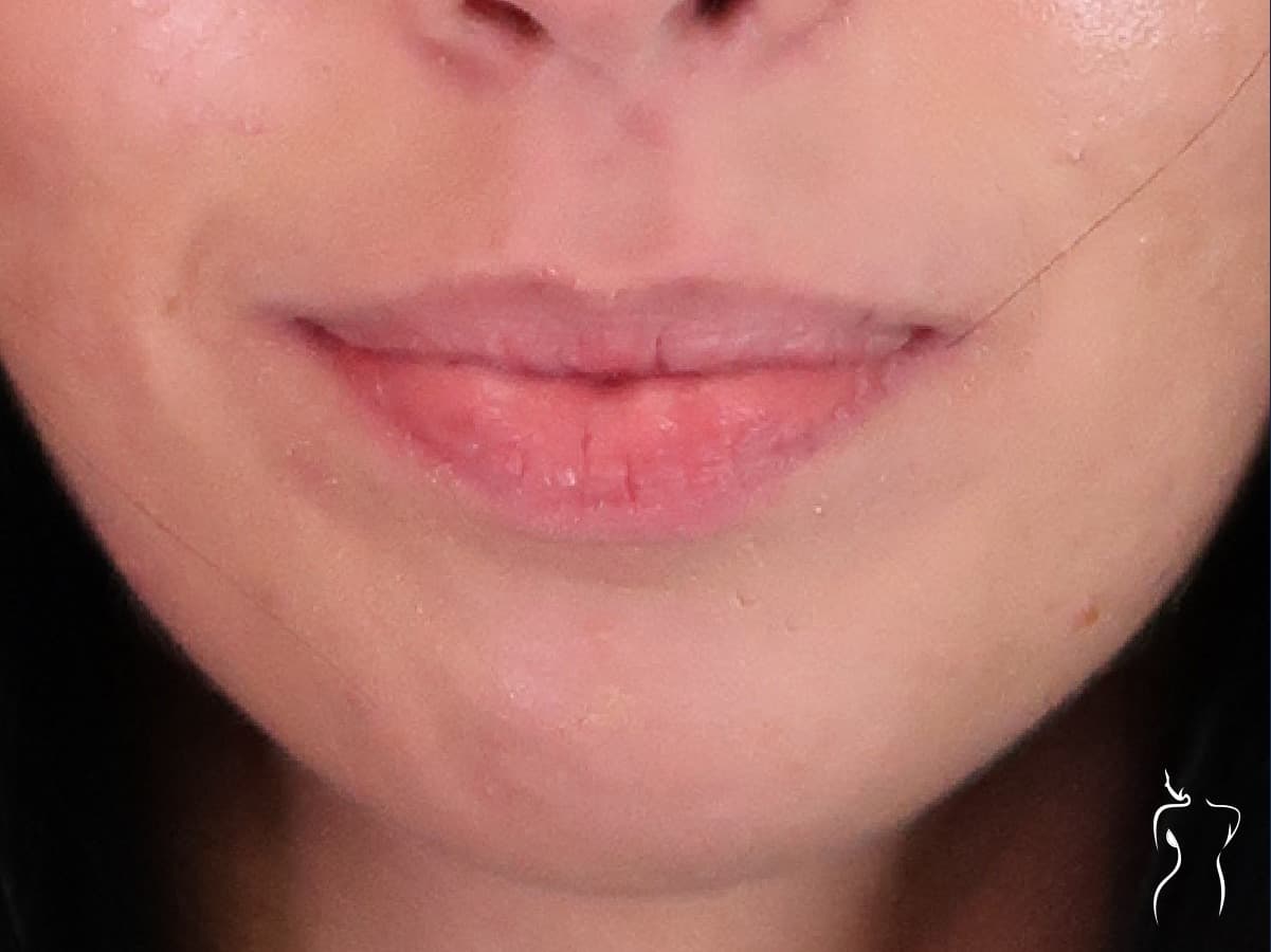 Dermal Fillers, before — actual patient of Dr. Day