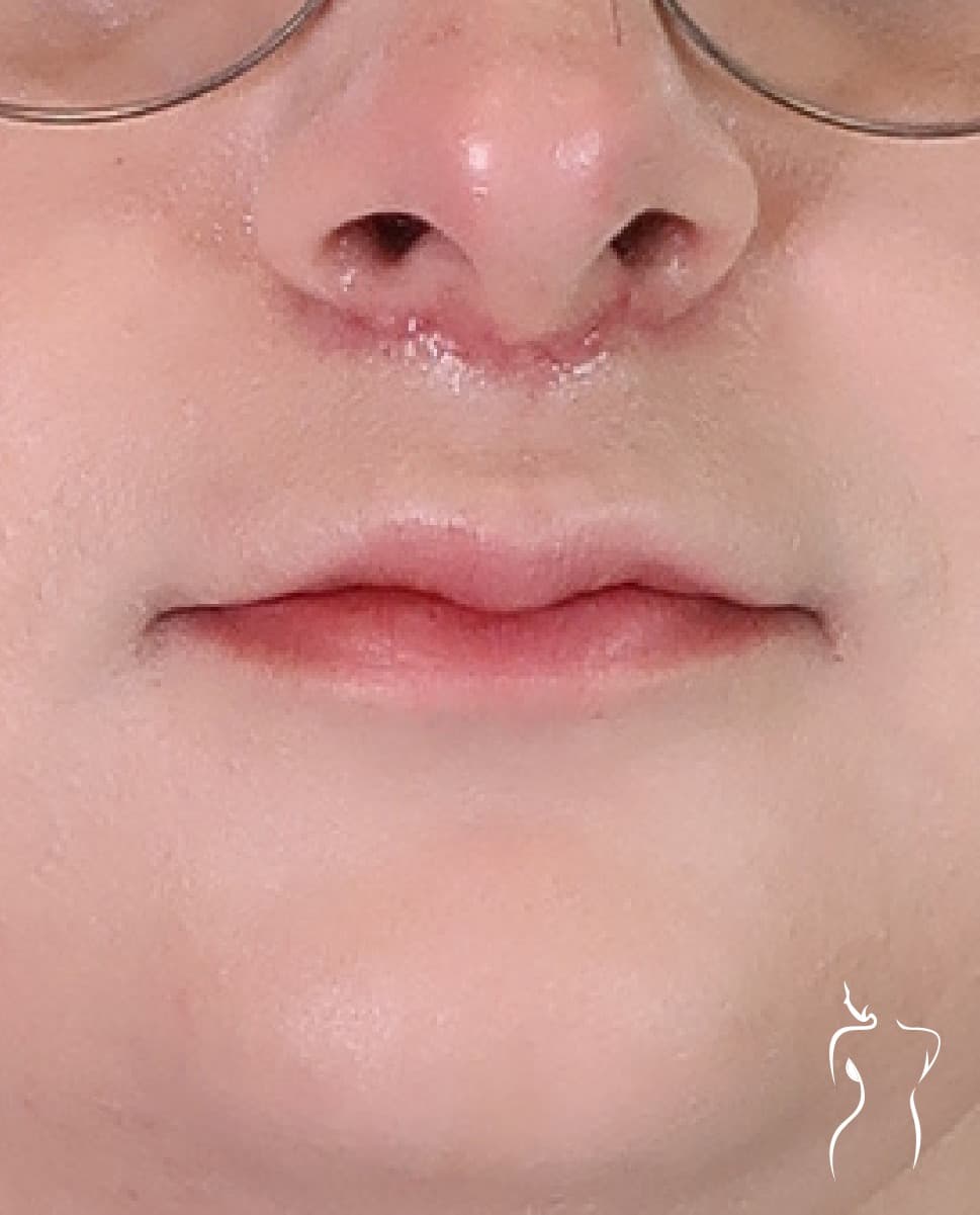 Lip Lift, after — actual patient of Dr. Day