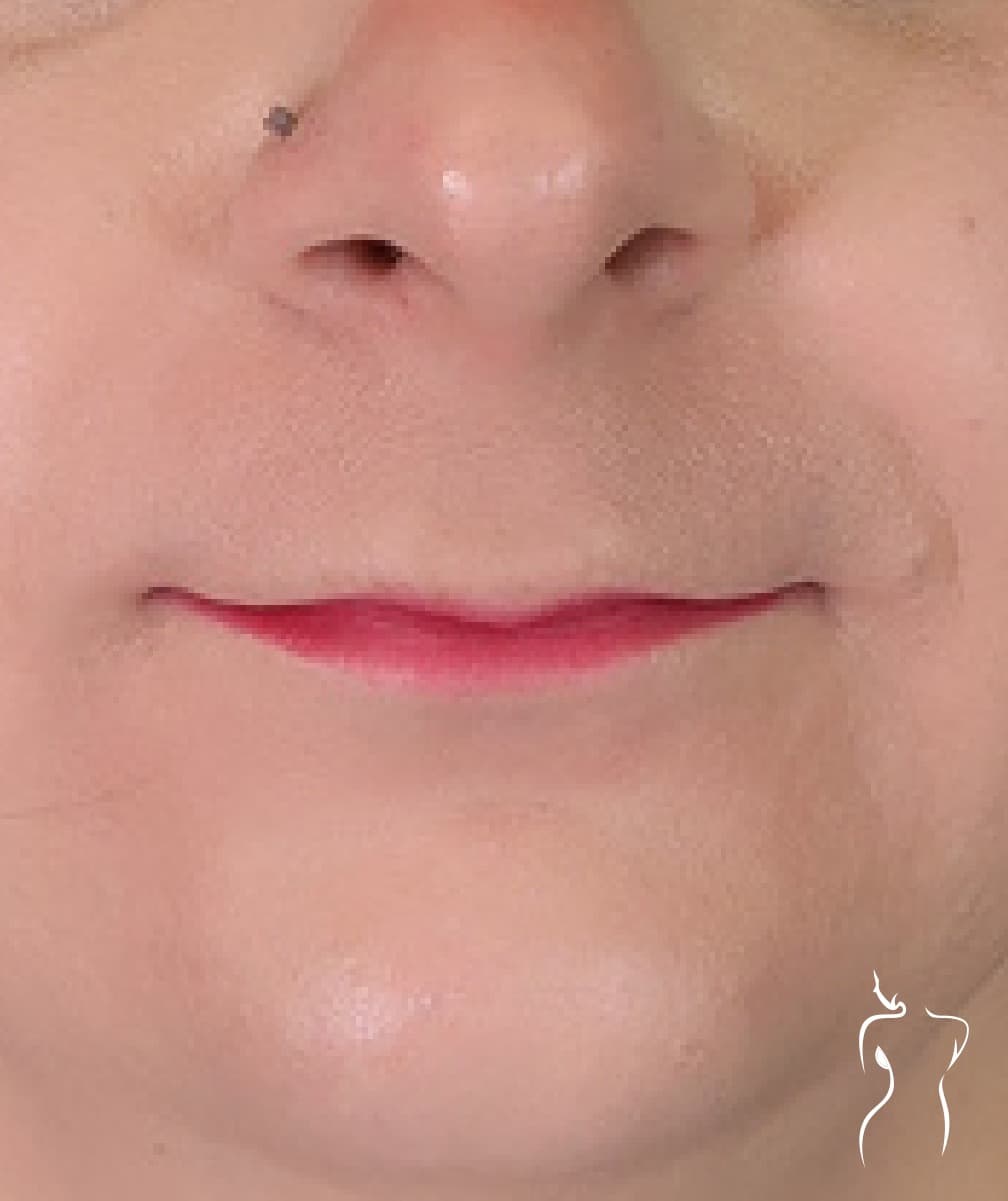 Lip Lift, before — actual patient of Dr. Day