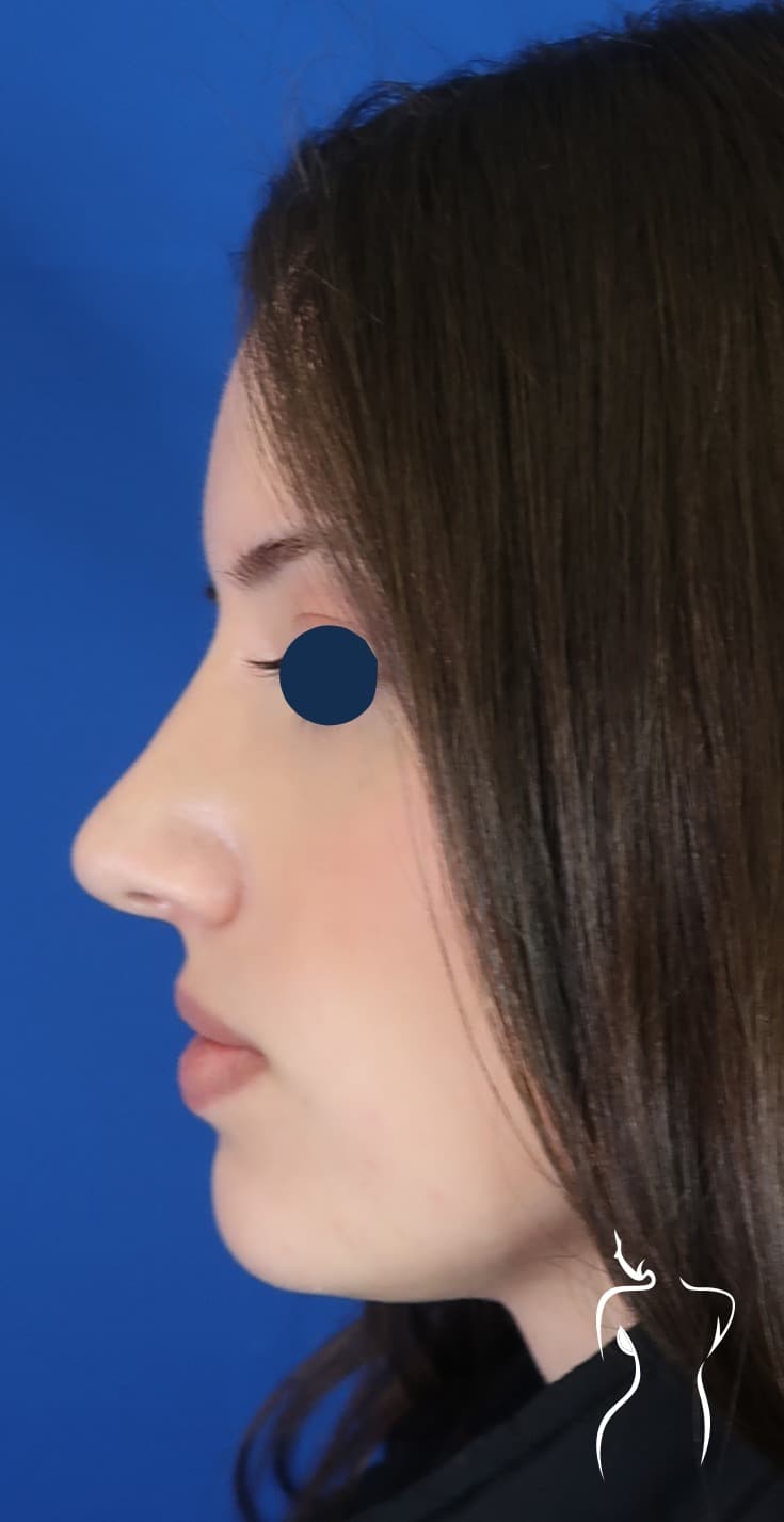 Non-Surgical Rhinoplasty, after — actual patient of Dr. Day
