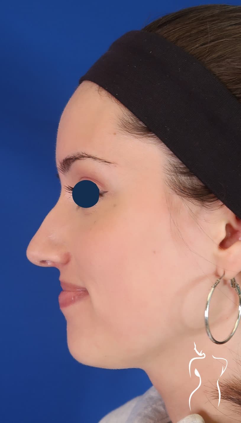 Non-Surgical Rhinoplasty, before — actual patient of Dr. Day