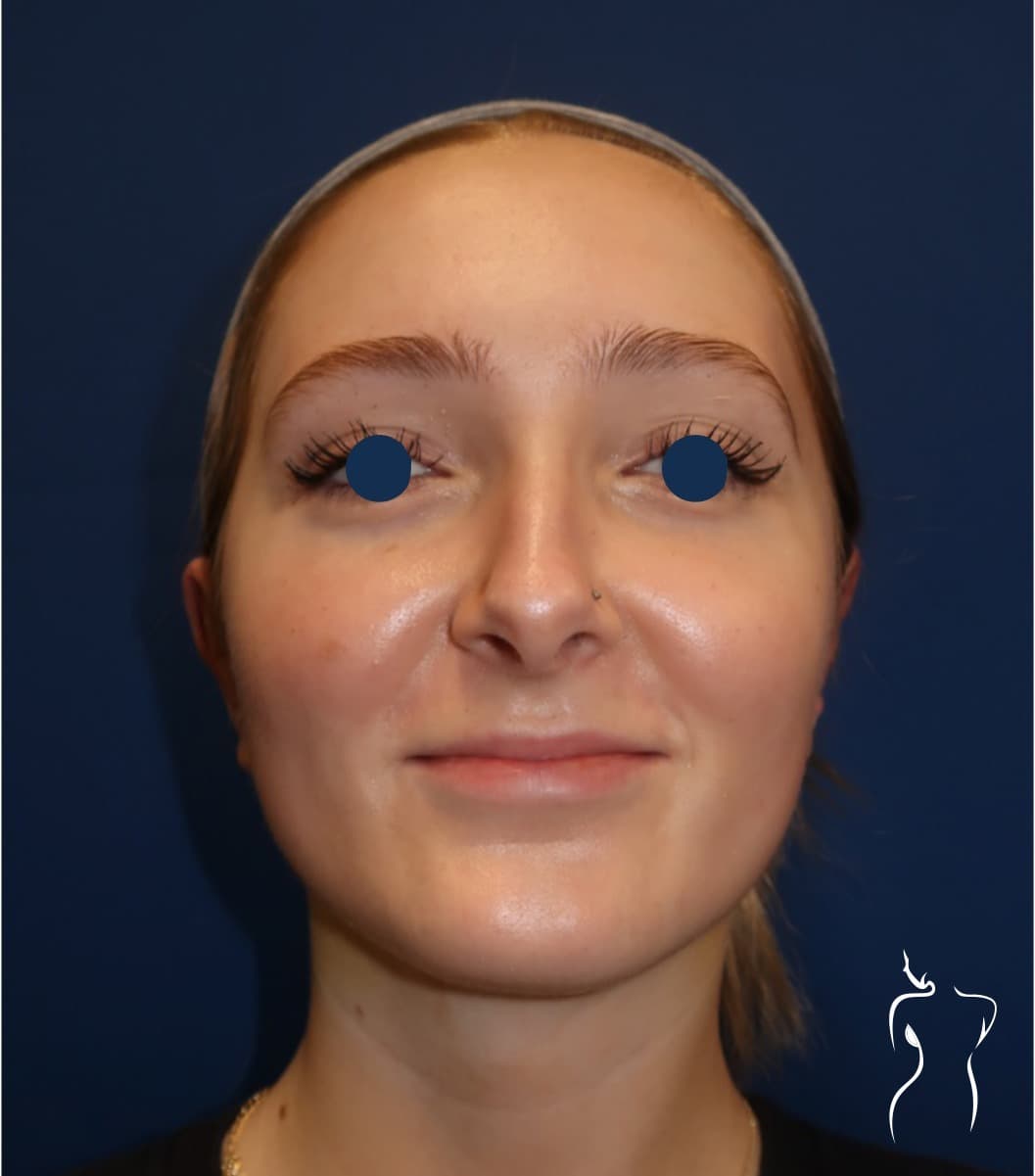 Otoplasty, after — actual patient of Dr. Day