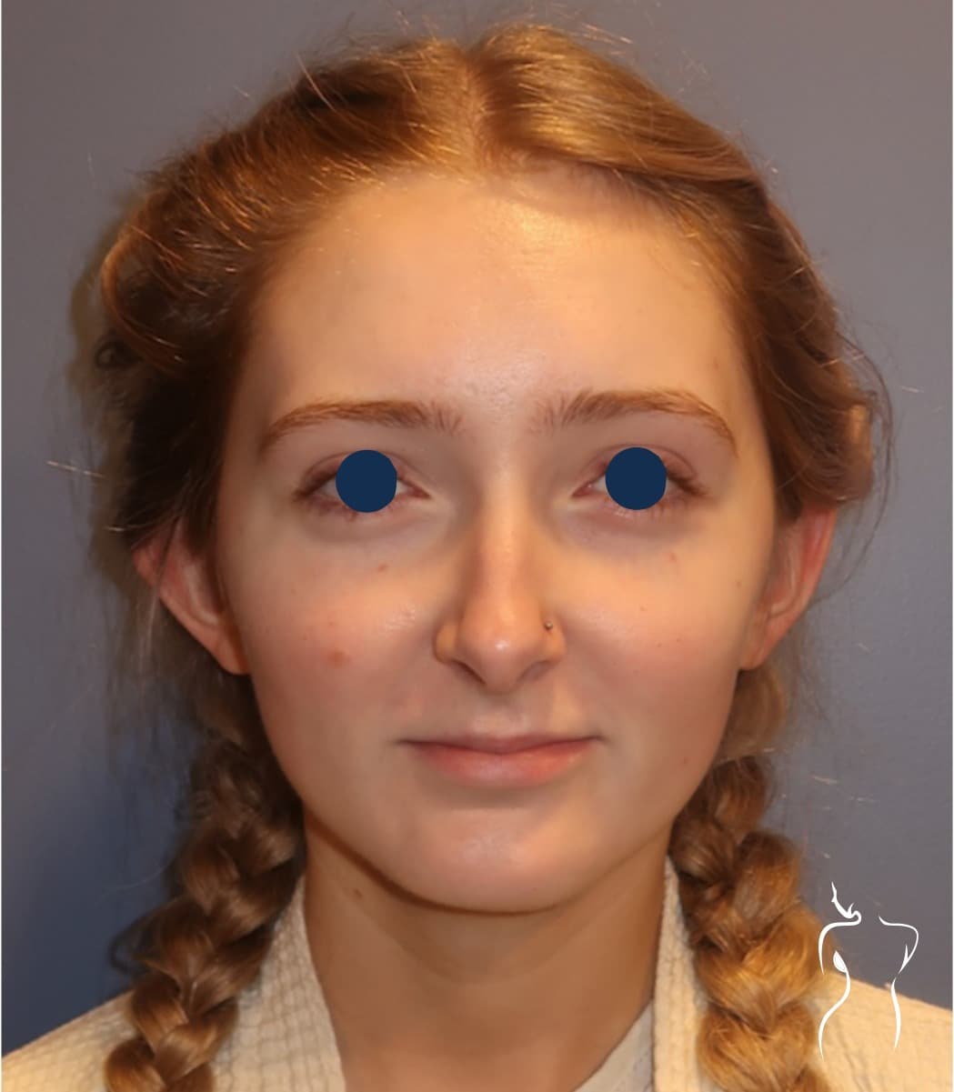 Otoplasty, before — actual patient of Dr. Day