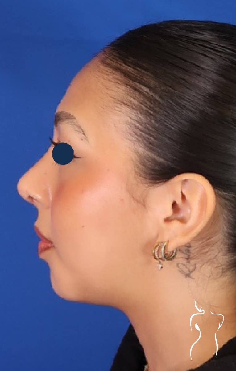 Rhinoplasty & Chin Implant, after — actual patient of Dr. Day