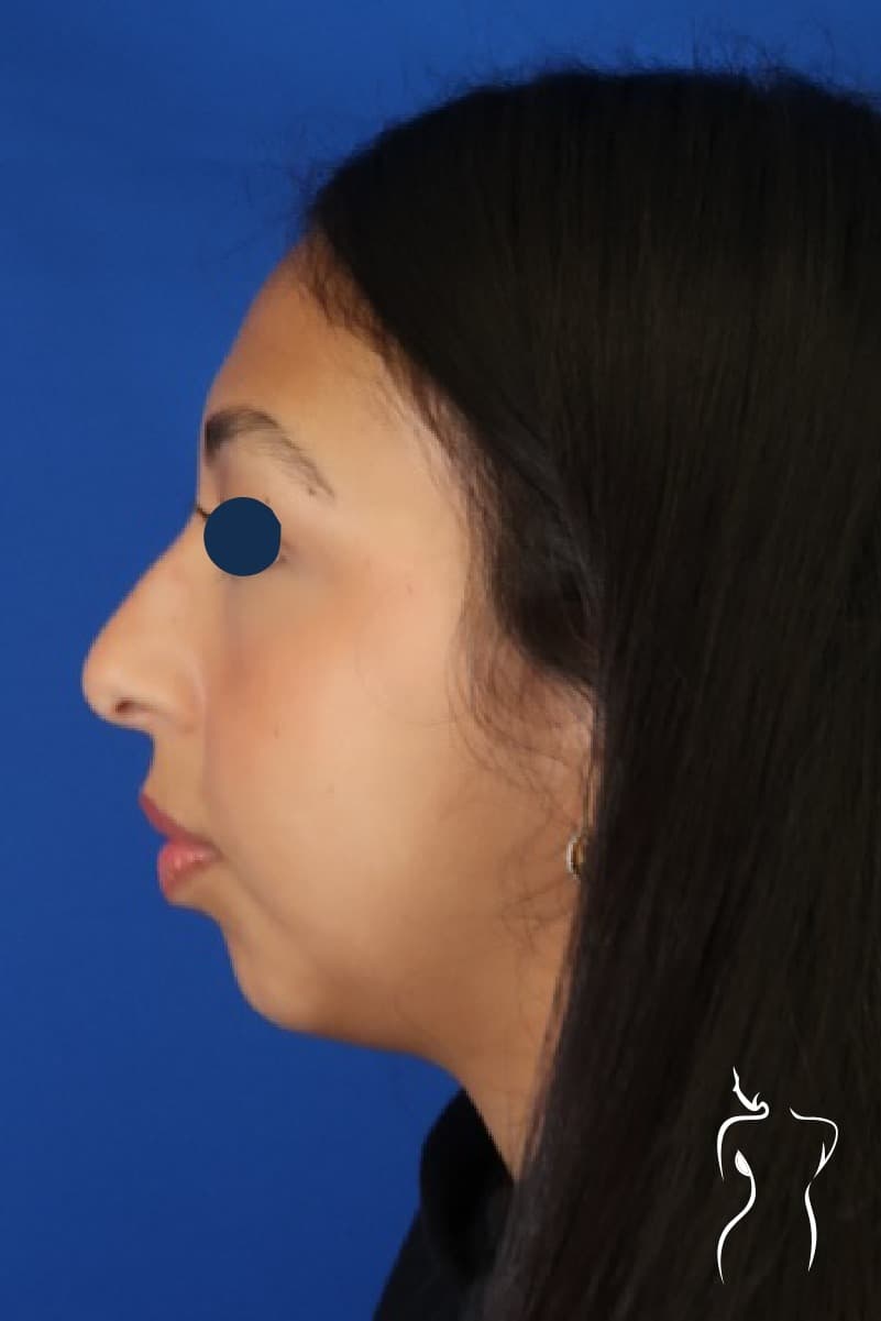 Rhinoplasty & Chin Implant, before — actual patient of Dr. Day